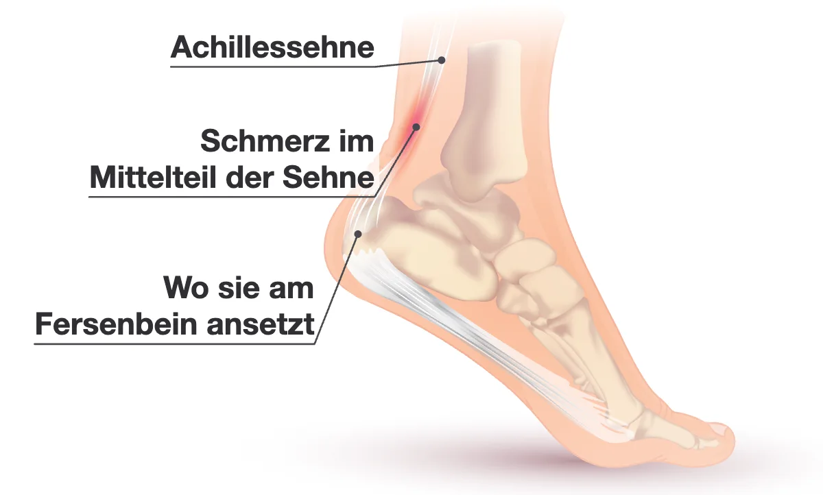 Fuß und Sprunggelenk von der Seite: die Achillessehne von der Wade bis zur Rückseite des Fersenbeins, mit einer roten Stelle im Mittelteil der Sehne.