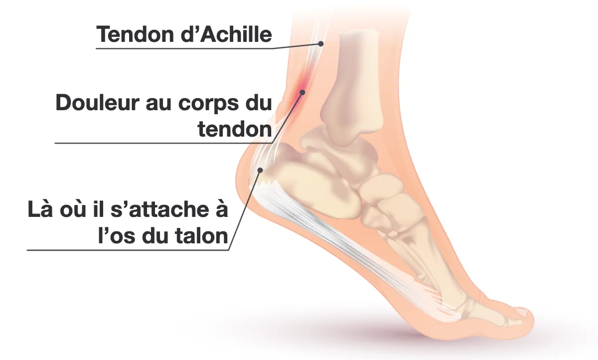 Vue de côté d’un pied et d’une cheville montrant le tendon d’Achille, du mollet jusqu’à l’arrière de l’os du talon, avec une zone rouge au milieu du tendon.