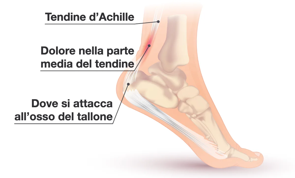 Vista laterale di un piede e una caviglia con il tendine d’Achille dal polpaccio alla parte posteriore dell’osso del tallone, e una zona rossa nella parte media del tendine.