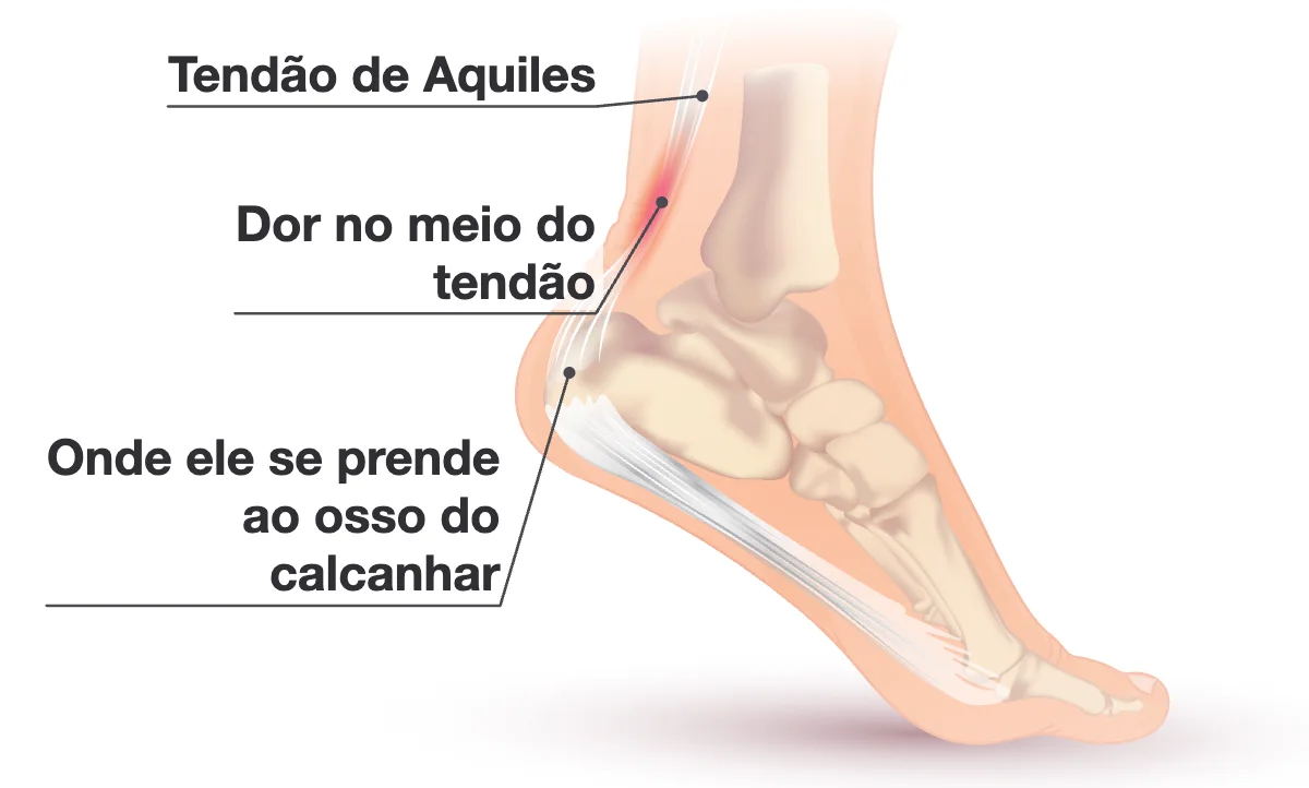 Vista lateral de um pé e tornozelo com o tendão de Aquiles indo da panturrilha até a parte de trás do osso do calcanhar, e uma área vermelha no meio do tendão.