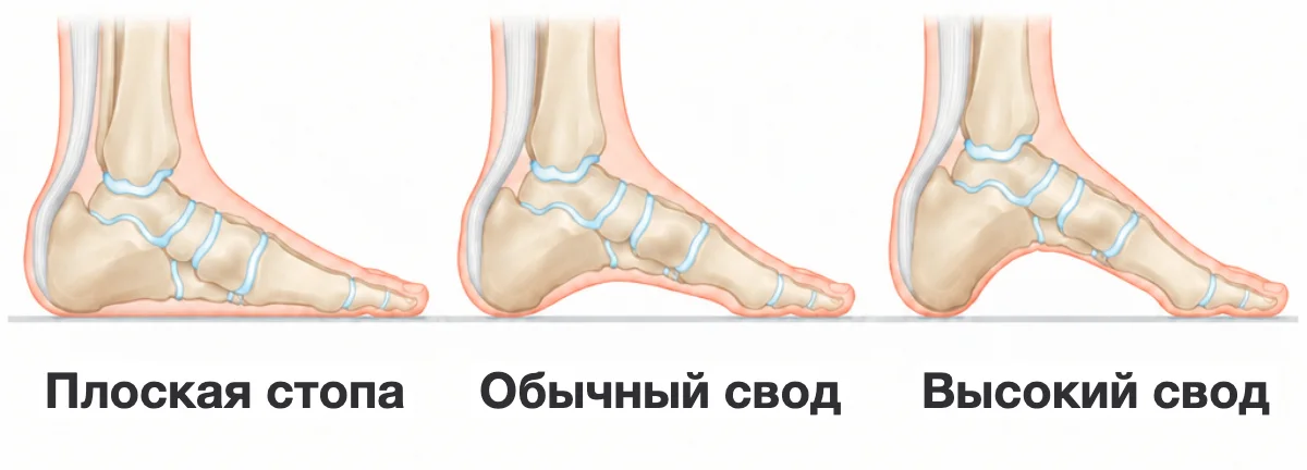 Три стопы с внутренней стороны: плоская стопа, у которой свод лежит на полу, обычный свод с небольшим просветом и высокий свод с большим просветом.