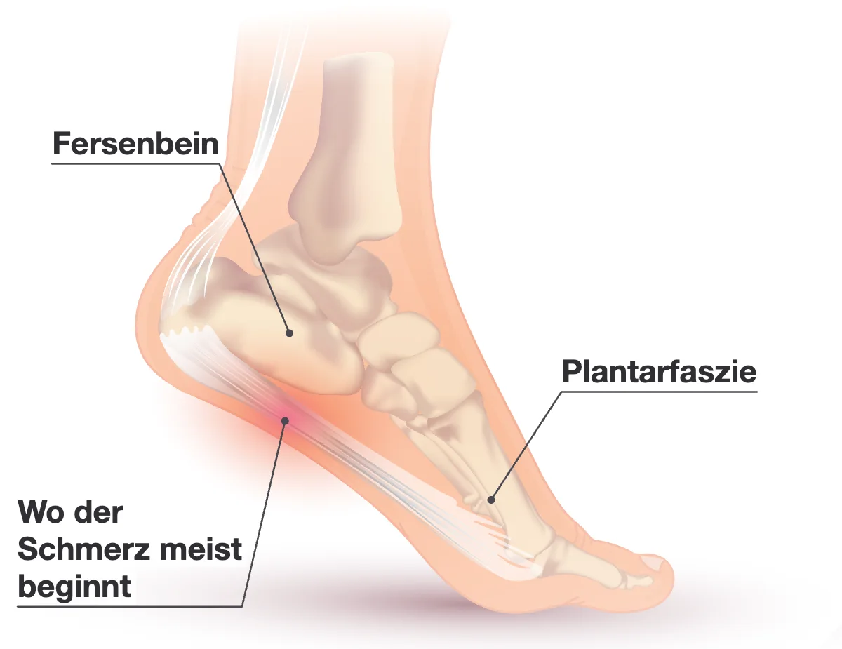 Fuß von der Innenseite mit durchsichtiger Haut: Fersenbein, Plantarfaszie unter dem Gewölbe und eine rote Stelle unter der Ferse, wo der Schmerz meist beginnt.