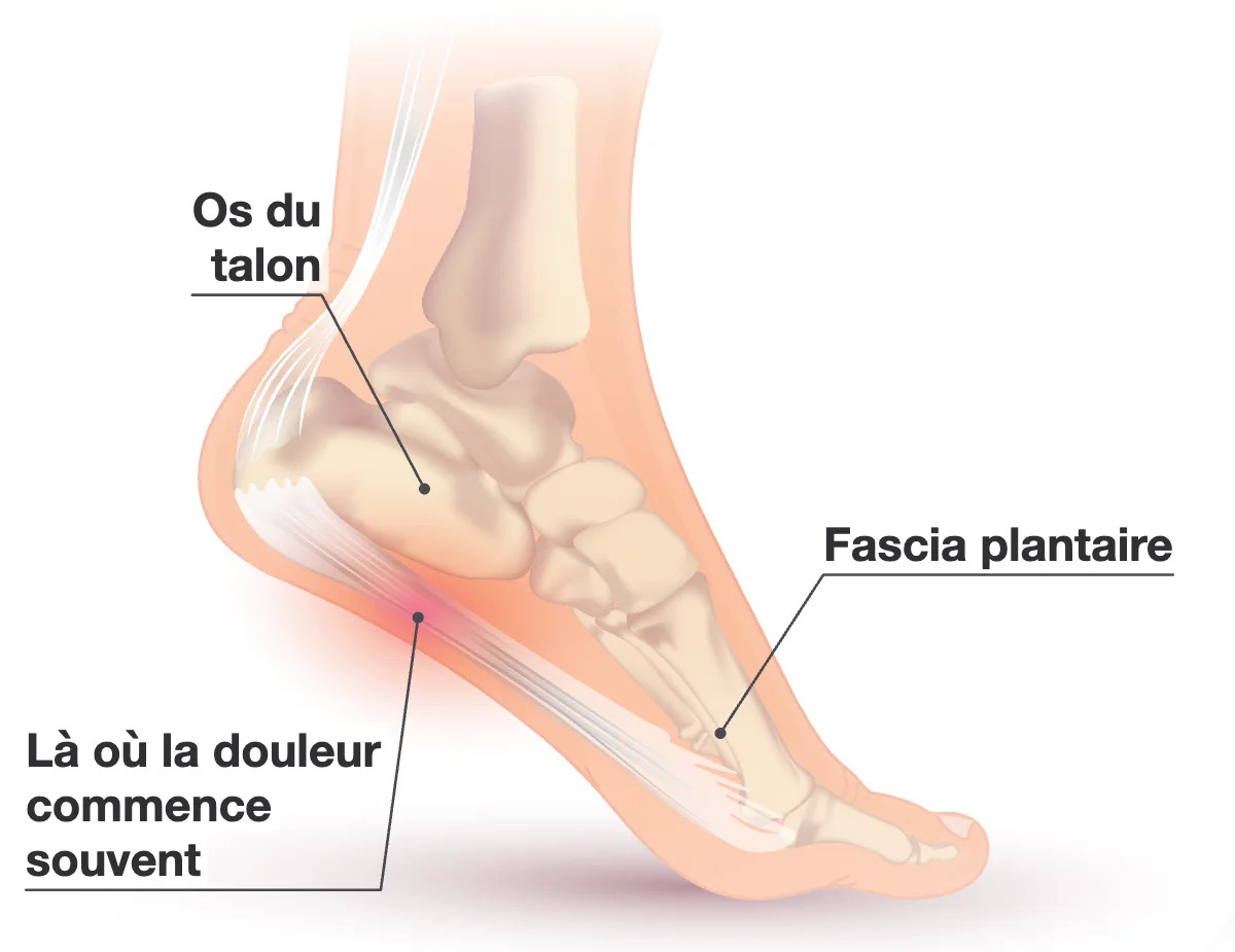 Vue de côté, face intérieure, d’un pied à la peau transparente montrant l’os du talon, le fascia plantaire sous la voûte et une zone rouge sous le talon là où la douleur commence souvent.