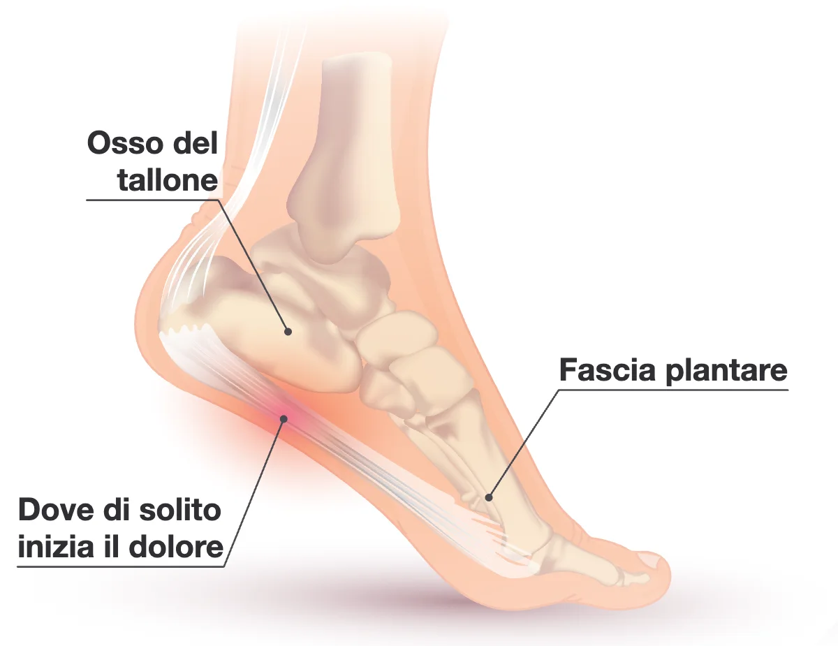 Vista laterale interna di un piede con la pelle trasparente che mostra l’osso del tallone, la fascia plantare sotto l’arco e una zona rossa sotto il tallone dove di solito inizia il dolore.
