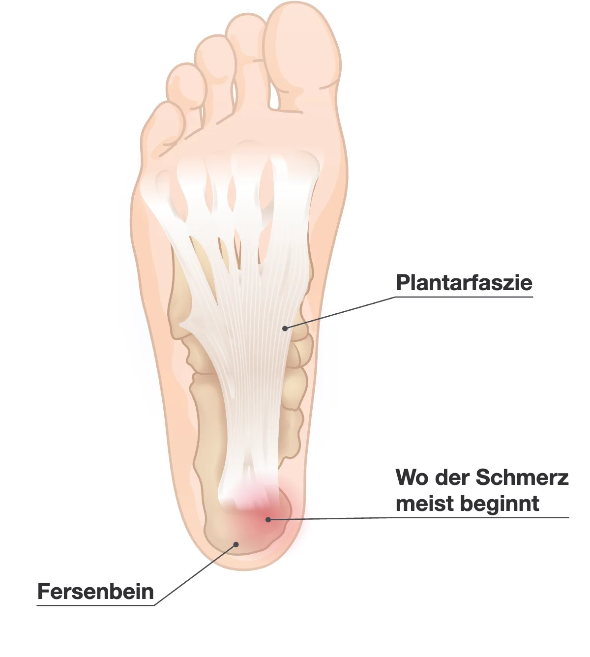 Fußsohle mit der Plantarfaszie als weiße Bänder, die sich vom Fersenbein fächerförmig bis zu den Zehen ausbreiten, und einem roten Fleck an der Ferse, wo der Schmerz meist beginnt.