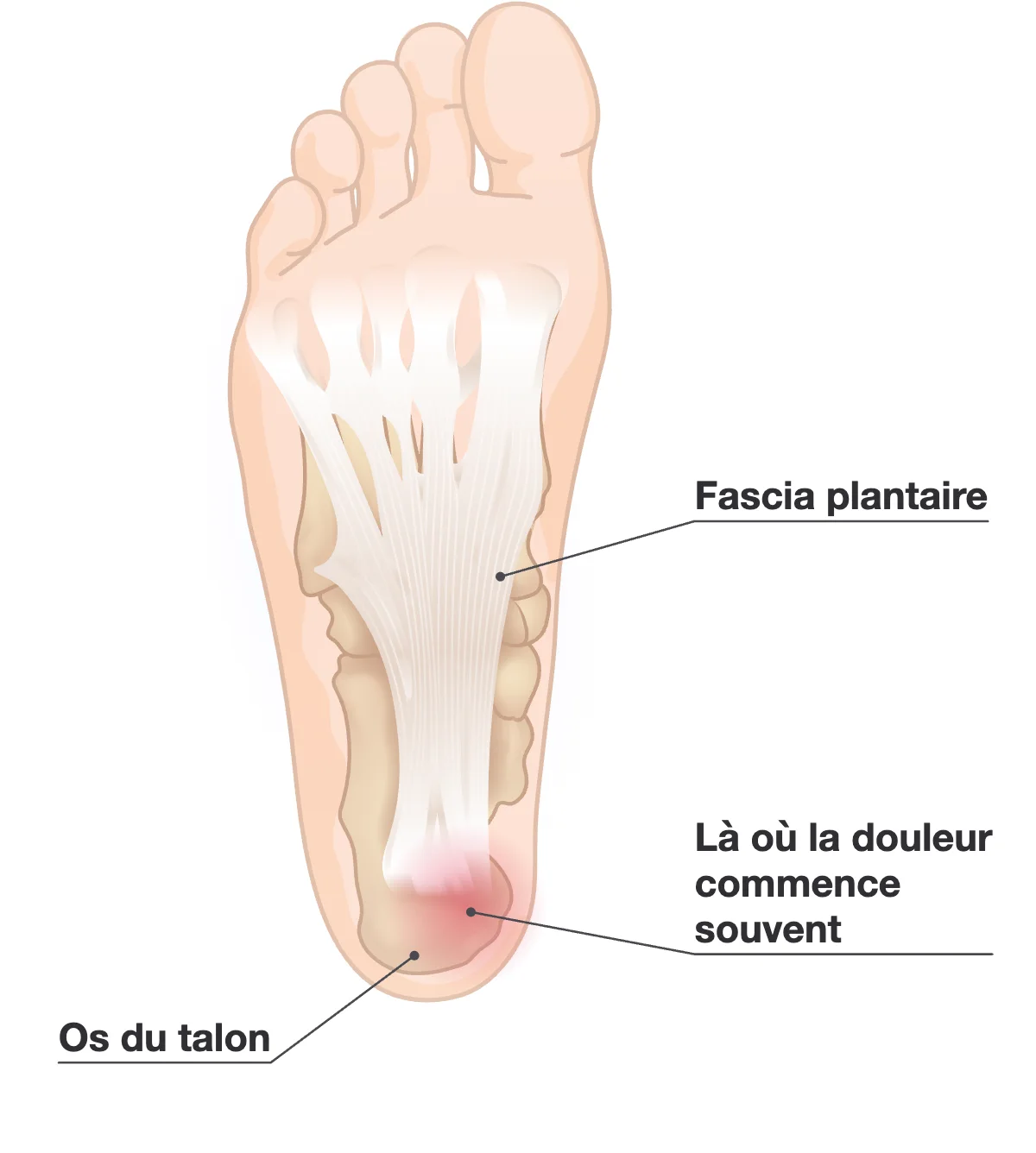Plante d’un pied montrant le fascia plantaire en bandes blanches qui s’étalent de l’os du talon jusqu’à la base des orteils, avec une tache rouge sur le talon là où la douleur commence souvent.