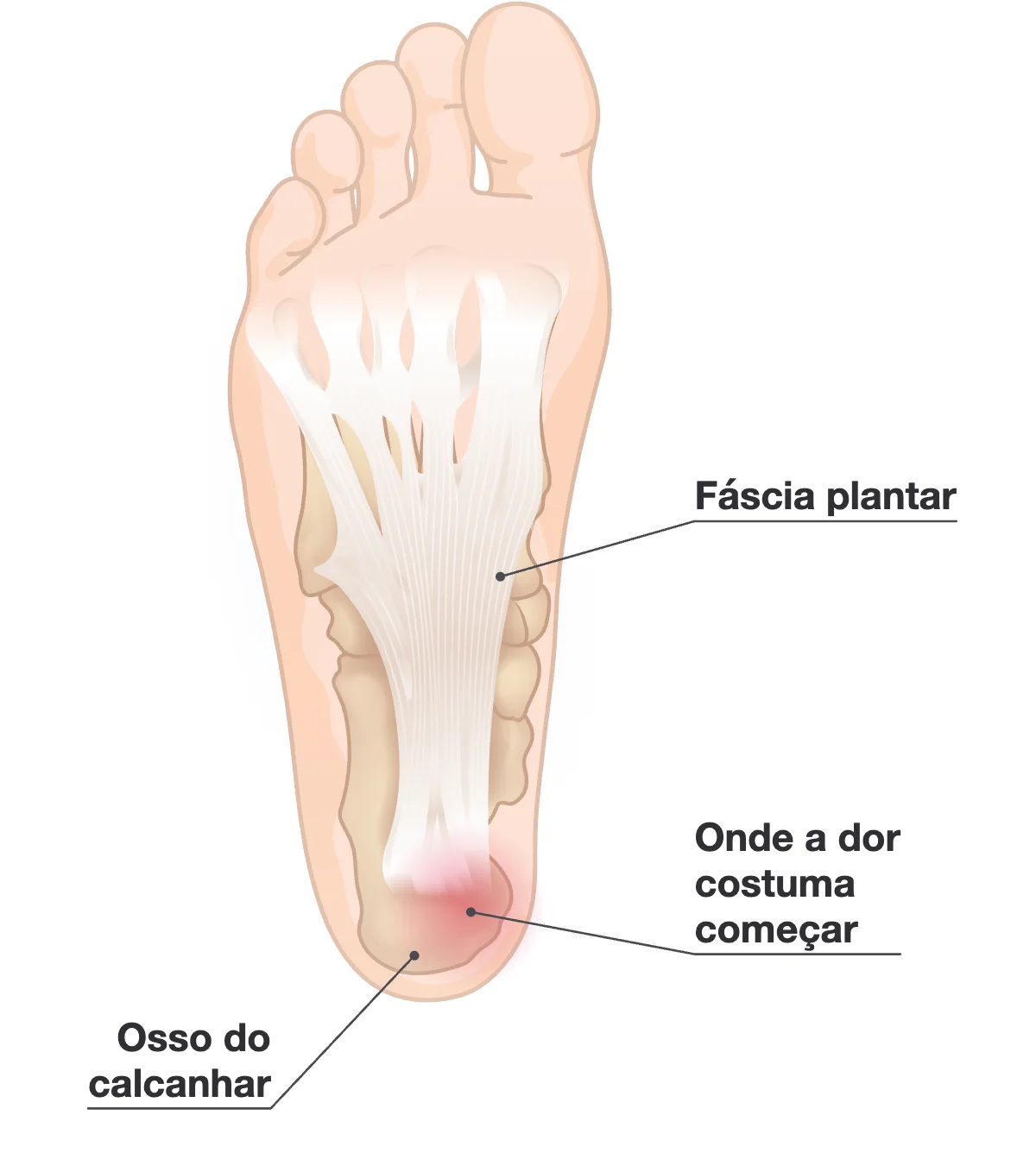 Sola de um pé com a fáscia plantar em faixas brancas que se abrem do osso do calcanhar até a base dos dedos, e uma mancha vermelha no calcanhar onde a dor costuma começar.