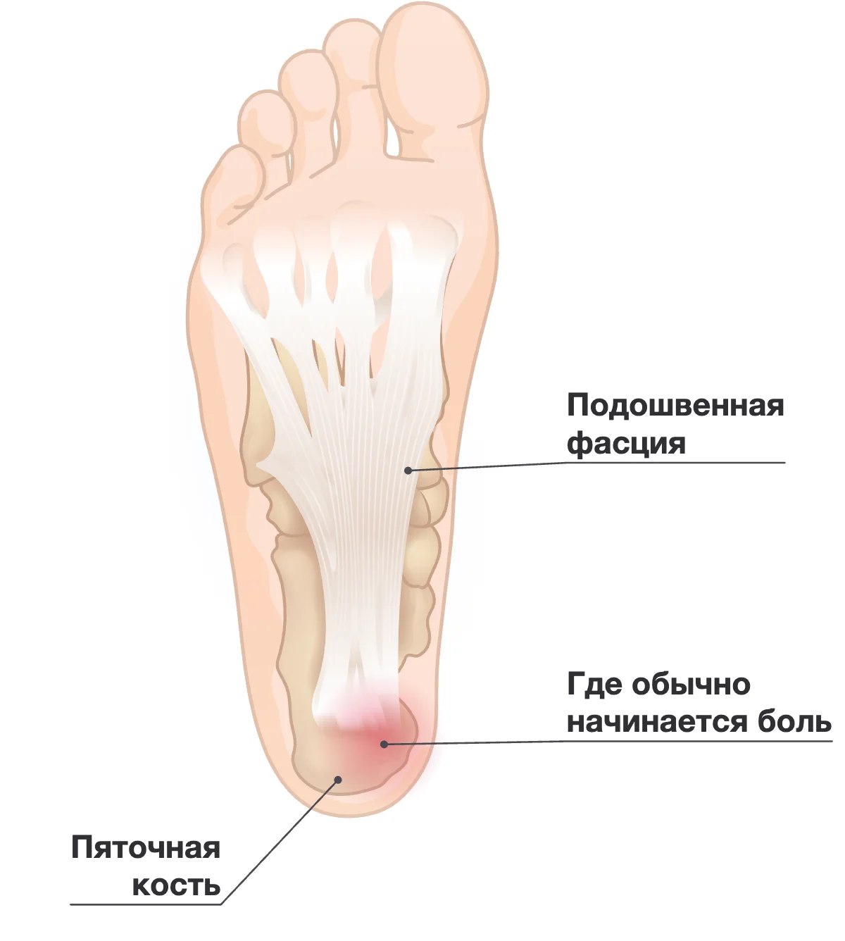 Стопа с внутренней стороны, подошвенная фасция выделена как полоса от пятки к подушечке стопы.