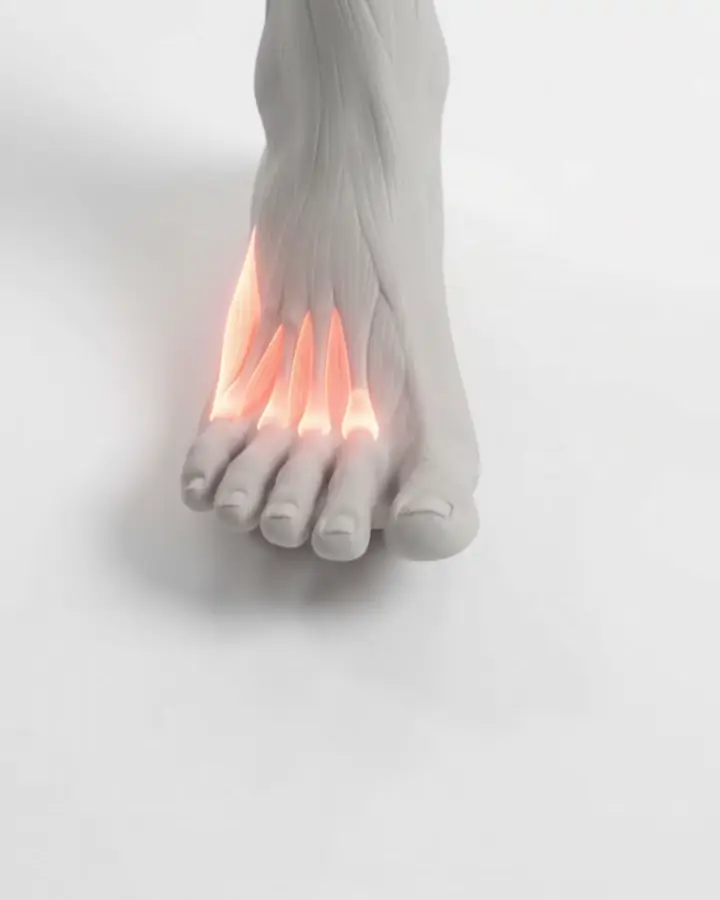 A foot with all five toes spread wide apart, the muscles between the metatarsals highlighted